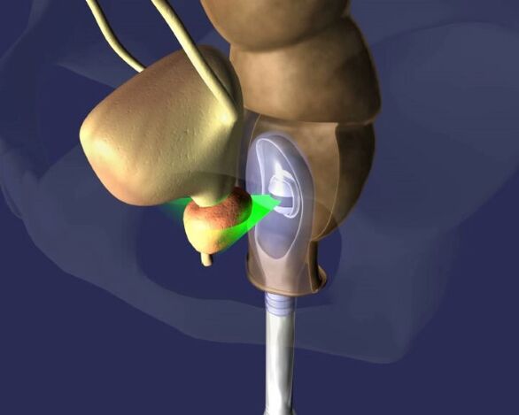 les effets des ultrasons sur la prostate dans la prostatite