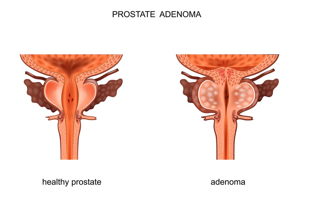 prostate saine et avec des adénomes